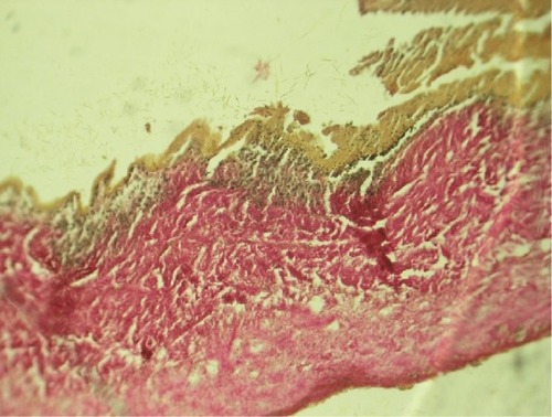 Figure 7 Micro-samples of bioprosthetic leaflet with endocarditis, stained with Van Gison. Original magnification ×100.