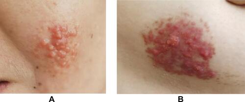Figure 1 Skin lesions observed on the third visit before diagnosis. (A) Red to yellow papules on her left cheek, measuring approximately 3 cm × 3 cm. (B) Papules and erythema on her left chest, measuring approximately 6 cm × 3.5 cm.