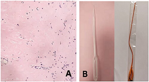 Figure 2. (A) The biopsy of the mass was stained with Congo red, and a clear circle appeared around the cells. (B) F10 Foley catheter.