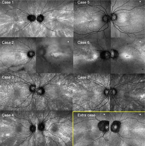 Figure 1 Radial FAF at the posterior pole.