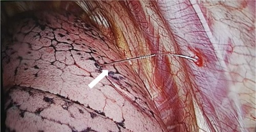 Figure 1 The pulmonary nodule was located by the hookwire insertion.