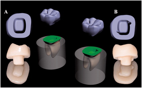 Figure 1. 3D model and milled in vitro restorations: (A) conventional endocrown preparation design and (B) modified endocrown preparation design.