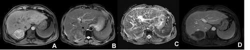 Figure 4 After microwave ablation, MRI showed: (A) T1-weighted image, (B) T2-weighted image, (C) ADC map, (D) enhanced image.