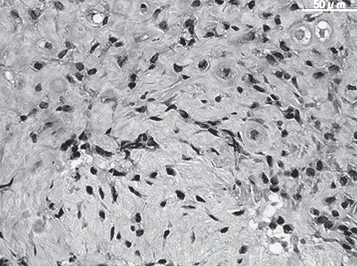 Figure 6.  Case 2. Needle biopsy of the left iliac spine showed polygonal cells with hyperchromatic nuclei. The stroma consisted of chondroid and osteoid tissues.