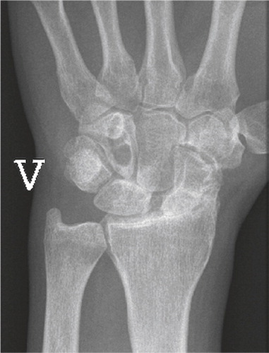 Figure 2. Radiograph of S-L ligament injury, with secondary degenerative changes, SNAC 3. Radioscaphoid and midcarpal arthrosis.