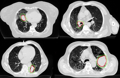 Figure 1. Representative axial slices (phase 50%) of four central tumors included in this study. Top left para-cardiac, top right hilar, bottom para-mediastinal (non-cardiac). The inner and outer outlines define the gross and planning tumor volumes, respectively.