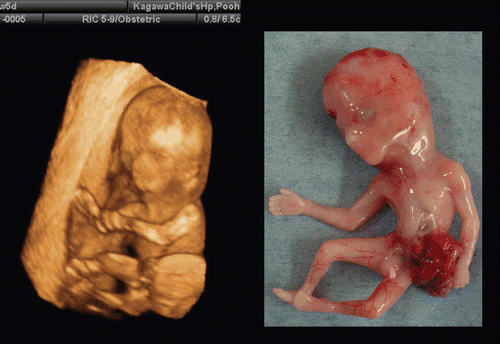 Figure 49.  Omphalocele at 12 weeks of gestation (left) 3D ultrasound image at 12 weeks and 5 days. (right) Macroscopic picture of aborted fetus. Hernial sac was ruptured at delivery.