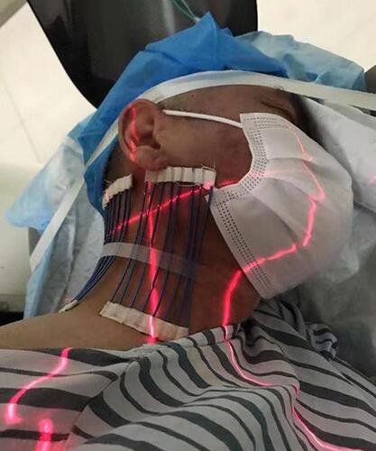 Figure 2 The patient was laid in a lateral position healthy side down on the CT imaging bed. The positioning grid was fixed on the neck of the affected side with adhesive tape.