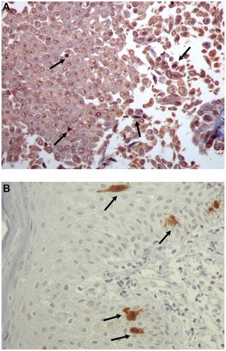 Figure 6 (A) Immunohistochemical analysis of the squamous papilloma with mild dysplasia of patient 2. The nuclei of some epithelial cells show positive staining (arrows) with antibodies to HPV proteins (×400) and (B) Immunohistochemical analysis of the squamous papilloma with mild dysplasia of patient 2. Only a few dysplastic epithelial cells were positive nuclear and cytoplasmic staining (arrows) for p16 protein (×400).