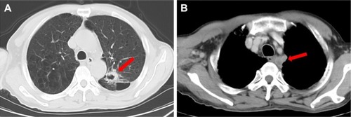 Figure 1 (A) Chest computed tomography revealed a lobulated soft tissue (2.7×2.3 cm, arrow) with an irregular hollow shadow in the posterior segment of the upper left lung lobe. (B) Mediastinal and perihilar lymph node metastases were noted (arrow).