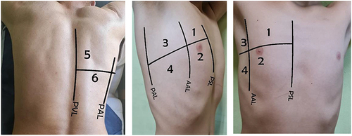 Figure 4 The lung ultrasonography score, based on the examination of 12 regions of interest (six on the right side and six on the left side), has been proposed to assess lung aeration changes caused by different pathological lung conditions. PSL: AAL: PAL: PVL.