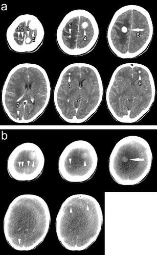Figure 1.  Brain tumor images acquired by planning CT (a) and kV CBCT (b) after each intravenous bolus administration of iodized contrast media. The treatment isocenter was set within the tumor indicated by the arrow. Tumors are indicated by the arrowhead. All tumors 6 mm or more in the greatest dimension in the planning CT (a) were also detectable in the CBCT (b). The numbers assigned in the tumor correspond to those in Table I.