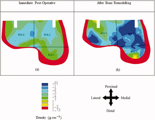 Figure 4. Bone density distribution at the talus bone after the immediate post-operative and bone remodelling condition.