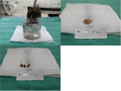 Figure 3 (A) Hair, (B) teeth, and (C) biopsy sample taken during the cystoscopy.