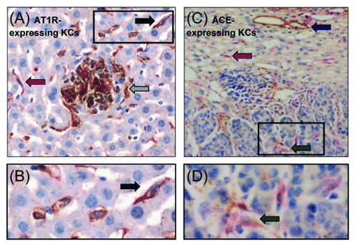 Figure 2. KCs express the AT1R and ACE in CRC liver metastases. Double immunostaining using the F4/80 and AT1R marker identified AT1R-expressing KCs in both the liver and tumors (black arrow) (A and B). AT1R-expressing non-F4/80 cells were also observed (gray arrow) (A). Double immunostaining also identified ACE-expressing KCs in both the liver and in tumors (green arrow) (C and D). However, not all KCs displayed AT1R or ACE expression (pink arrow) (A and C). ACE expression was also localized on vascular endothelial cells (blue arrow) (C).