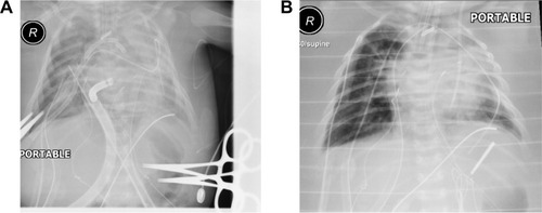 Figure 1 Pictures of chest radiographs during ECMO therapy.