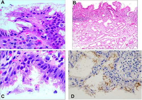 Figure 2 Degeneration of the surface epithelial cells on the gastric mucosa in the presence of Hp infection. (A) Massive adherence of Hp on the mucus layer and surface epithelial cells covered by the gastric mucosal surface epithelium; H&E staining, × 400. (B) A characteristic Hp infection band was visible on the routine pathological section under low magnification; H&E staining, ×10. (C) Cobweb-like vacuolar degeneration of the cytoplasm of the surface epithelial cells. With different degrees of cytoplasmic destruction and detachment, a small amount of cytoplasm remained around the nucleus in a radial structure; finally, the nucleus also degenerated and detached; H&E staining, ×400. (D) Positive for Hp, EnVision method, ×400.