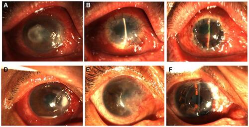 Figure 2 Cases of graft failure. (A–C) Cornea status at preoperation, rejection episode 3 months after APCS transplantation, and after treatment with PKP in infectious central corneal ulcer group. (D–F) Cornea status prior to surgery, at 3 months after APCS transplantation, and after treatment with PKP in infectious peripheral corneal ulcers. APCS, acellular porcine corneal stroma; PKP, penetrating keratoplasty.