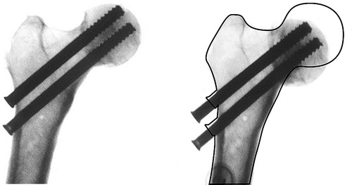 Figure 19. A typical example of plastic deformation of the proximal femur following cyclic loading.