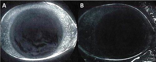 Figure 4 Representative Case. A 62-year-old male presented with moderate DED (DEWS 3) demonstrated by positive fluorescein staining (A). After 2 day treatment with cAM, the ocular surface healed with a stable tear film and clear cornea (B).