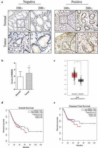 Figure 1. RREB1 is highly expressed in gastric cancer tissue but has no significantly with the prognosis of patients
