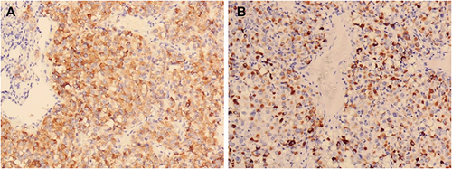 Figure 3 The tumor cells showed immunohistochemical positivity for Melan-A (A) and Desmin (B).