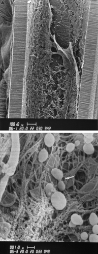 Figure 1.  A: Intraluminal biofilm on a central venous catheter (with detachment). Scanning electron microscopy (magnification×180). B: Biofilm of Staphylococcus epidermidis on a catheter surface with embedded staphylococcal cells within the matrix. The arrow shows dividing cocci. Scanning electron microscopy (magnification×15,000). 1µ=1µm=0.001 mm.