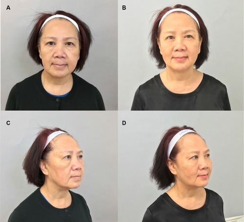 Figure 5 Treatment of the whole-face by RAD hyperdilution.