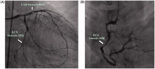 Figure 1. A typical sample of coronary heart disease patient (case no. 17 in Table 1) who got the cardiac diagnosis in the Cardiac Catheterization Laboratory. The three major arteries are: the right coronary artery (RCA) and two major branches of the left coronary artery, i.e., the left anterior descending artery (LAD) and left circumflex artery (LCA).