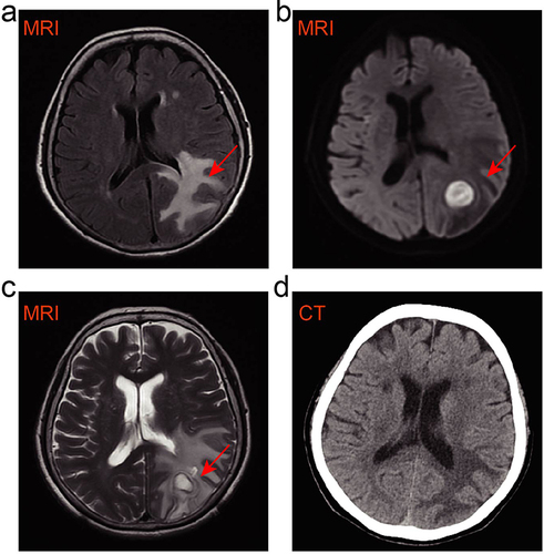 Figure 1 Imaging changes documented the alleviation of brain lesions during the timeline of treatment (a) The initial image of brain MRI at external healthcare center, and the section that indicated by red arrow represented intracranial space-occupying lesions. (b) The image of brain MRI before surgery in our hospital, the region that indicated by red arrows suggested further exacerbation of brain lesion. (c) The image of brain MRI in early postoperative, the region that indicated by red arrow documented the removal of cerebral abscess and existence of perilesional edema. (d) The brain CT scan of day 25 after surgery, documented recovered well of brain lesions without a relapse.