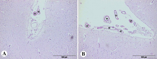 Figure 1 Congo red staining (semi-quantitative evaluation), magnification 100x: (A) grade + (low number of the positive blood vessels of Congo red positive vessels in the total number of vessels in field), (B) grade ++ (moderate number of Congo red positive vessels in the total number of vessels in field).