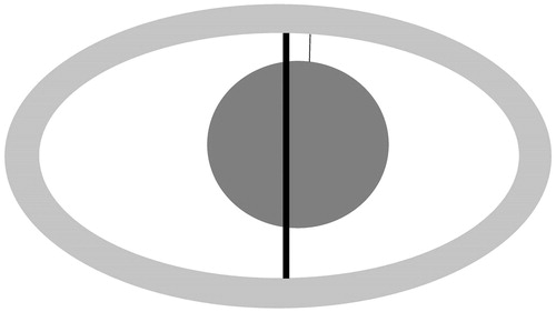 Figure 2. Schematic depiction of the ablation zone and of the measurement methods. The safety margin was measured as the shortest distance (thin line) between the tumour (dark grey) and the peripheral rim (light grey). The short-axis diameter used for the indirect measurements is shown as the thick line.