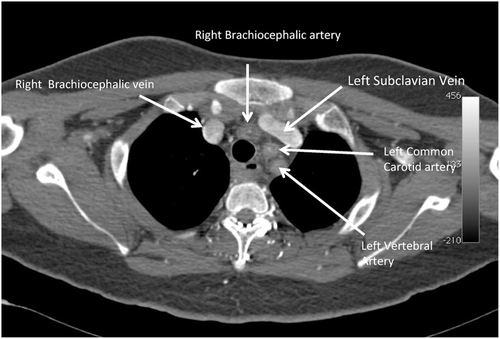 FIGURE 3  CT aortogram showing severely stenosed right brachiocephalic trunk, left common carotid artery, and left vertebral artery.