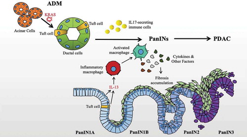 Figure 1. Relationship of Tuft Cells, ADM, PanIN formation, and PDAC. Tuft cells are expanded during KRAS-associated ADM, serve an immunomodulatory role with implications for PanIN development and fibrosis via cytokine signaling, and generally disappear with advanced disease