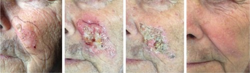 Figure 1 Clinical aspects at baseline, during and after ingenol mebutate treatment in a 65-year-old man.