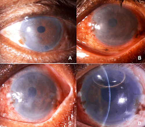 Figure 3 (A) Digital slit lamp image of a patient post DMEK, depicting stromal edema in the inferior one-third of cornea suggestive of early graft rejection.(B) Digital slit lamp image of a patient on a postoperative day 1, post-DMEK, depicting corneal haze with stromal edema suggestive of primary graft failure. (C) Digital slit lamp image of a patient on postoperative one month, post DMEK, depicting conjunctival congestion, corneal haze with stromal edema suggestive of primary graft failure. (D) Digital slit lamp image of a patient post DMEK following rebubbling, depicting clear cornea, well opposed lenticule with an air bubble occupying 1/3rd anterior chamber.