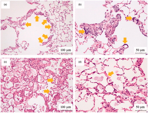 Figure 6. Histopathology of the rat lungs (HE staining) 104–105 weeks after a single intratracheal instillation of SWCNTs. Arrows indicate fibrosis at terminal bronchiole with deposit of the test substance in SWCNT-2 group (a), mineralization at terminal bronchiole in SWCNT-2 group (b), macrophage engulfing the test substance in SWCNT-3 group (c) and fibrosis at alveolar wall in SWCNT-3 group (d).