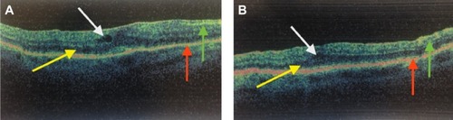 Figure 1 Improvement in central macular thickness on optical coherence tomography after undergoing epiretinal membrane peeling.