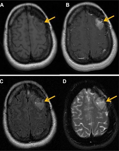 Figure 1 Magnetic resonance findings in GBM.Notes: (A) T1 pre-contrast images exhibit a hypointense lesion in the left frontal lobe region (arrow). (B) Axial T1 post-contrast images, after injection of 20 cc of intravenous MultiHance®, demonstrate a focus of enhancement in left frontal lobe. (C) Axial T2 FLAIR images show increase in FLAIR signal in the left frontal lobe, which demonstrates enhancement. (D) T2 FSE images also demonstrate increase in signal in the region of the left frontal lobe.Abbreviations: FLAIR, fluid-attenuated inversion recovery; FSE, fast spin-echo; GBM, glioblastoma multiforme.