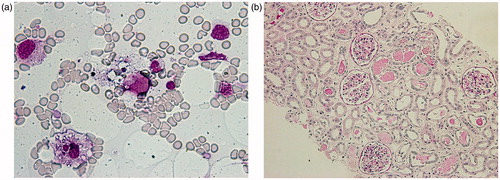 Figure 2. (a) Wright–Giemsa staining of the bone marrow aspirate. There are two macrophage-phagocytosing erythrocytes and platelets (original magnification ×400). (b) Periodic acid-Schiff staining of renal necropsy specimen. There is some cell infiltration in the interstitium and no acute tubular necrosis, although detachment of tubular cells due to postmortem changes was detected. There is remarkable edema in the interstitium and some protein casts with intact glomeruli (original magnification ×100).