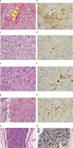 Figure 3. H-E staining of the bone marrow (a), liver (c), spleen (e), thrombus (g) and lung (i) at autopsy. Infiltration of dysplastic megakaryocytes was confirmed with anti-CD42b immunostaining in the bone marrow (b), liver (d), spleen (f), thrombus (h) and lung (j). Arrows and arrowheads indicate abnormal megakaryocytes with staghorn-like and cloud-like nuclei, respectively (a).