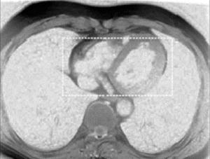 Figure 1. Axial MRI image of lungs with heart contained within a specified rectangular area.