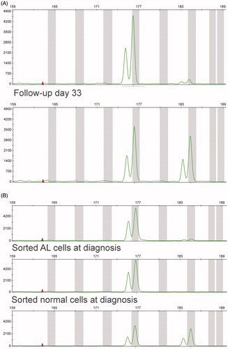 Figure 1. STR results of patient IR-16. (A) Diagnostic sample (top row) versus follow-up (bottom row). In the diagnostic sample, an STR for THO (11p) seems missing as compared to the follow-up sample. (B) Nonsorted cells (top row) versus sorted ALL cells (middle row) and sorted normal cells (bottom row) of the same patient clearly show specific loss of a STR in the leukemic cells.