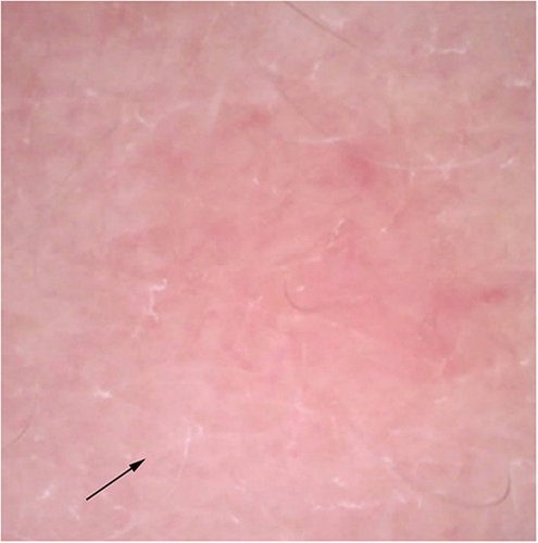 Figure 11 2 months after termination of treatment, the vascular network has almost completely disappeared. The black arrow indicates the same landmark for comparative dermoscopic observations.