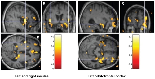 Figure 2 Clusters of at least 10 voxels in bilateral insulae and left orbitofrontal cortex where the t-contrast for increase between baseline and 2-month FDG-PET normalized metabolic activity had P values <0.01. Color bars indicate t statistic values. Volumes of interest are shown on the T1-weighted template created from the average of all 16 participants with frontotemporal atrophy in the MNI space.Abbreviation: MNI, Montreal Neurological Institute.