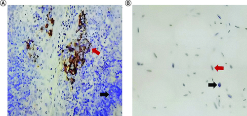 Figure 2. Immunohistochemistry images of the tumor.Immunohistochemistry for control tissue (A) and liposarcoma of this patient (B). Black arrows indicate negative staining, and red arrows indicate positive staining.