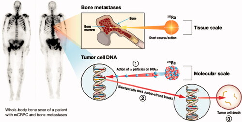 Figure 5. Alpha therapy is an effective treatment for bone metastases. Radionuclides such as radium which home to the bone inherently execute targeted therapy of bone metastases.