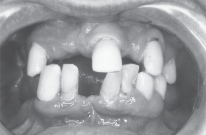 Figure 1 Extensive tooth loss is frequent in the elderly.