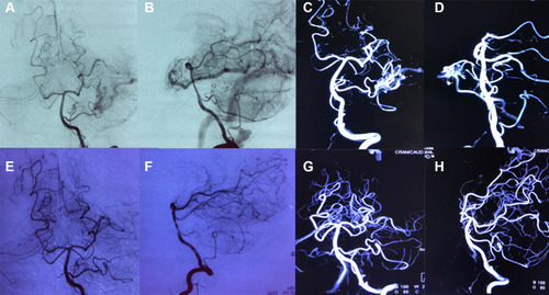 Figure 2 Preoperative and postoperative DSA images of the 13-year-old girl’s cAVMs. (A) Preoperative anteroposterior views show a small AVM supplied by a branch of the posterior cerebral artery. (B) Preoperative lateral views show that the vein was draining into the superior petrosal sinuses. (C) Preoperative views from anteroposterior 3D DSA showing the AVM structure. (D) Preoperative views from lateral 3D DSA showing the AVM structure. (E and F) Postoperative anteroposterior and lateral views showing that the AVM had disappeared. (G and H) Postoperative anteroposterior and lateral views from 3D DSA showing that the AVM had been completely excised.