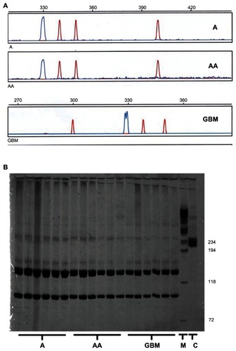 Figure 2 Absence of activating Flt3 mutations in astrocytic gliomas. (A) Examples of GeneScan analyses of 6-FAM-labeled polymerase chain reaction fragments spanning the Flt3 region, in which internal tandem duplications can occur. The tumor samples analyzed show the wild-type peak at a mean fragment length of 330.07 ± 0.37 bp. No sample contained additional peaks around 400 bp or of any size compatible with internal tandem duplications up to a size of 500 bp. The double peak in the GBM sample merely reflects an overlap between two peaks with a distance of 0.85 bp, which can be interpreted as a polymerase chain reaction artifact. (B) Diffuse astrocytomas (A), anaplastic astrocytomas (AA), and glioblastomas (GBM) were screened for the D835 point mutation.